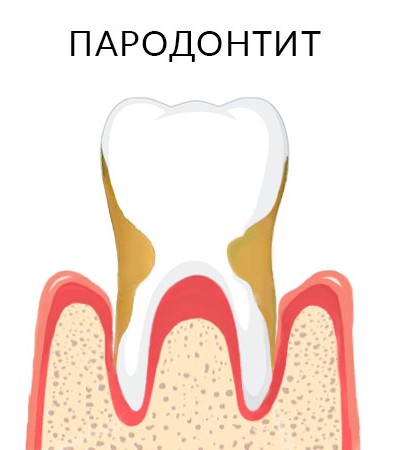 Пародонтит