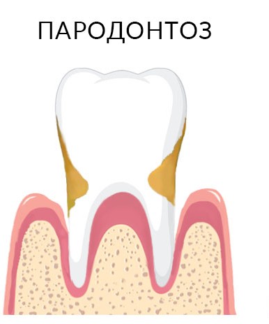 Пародонтоз